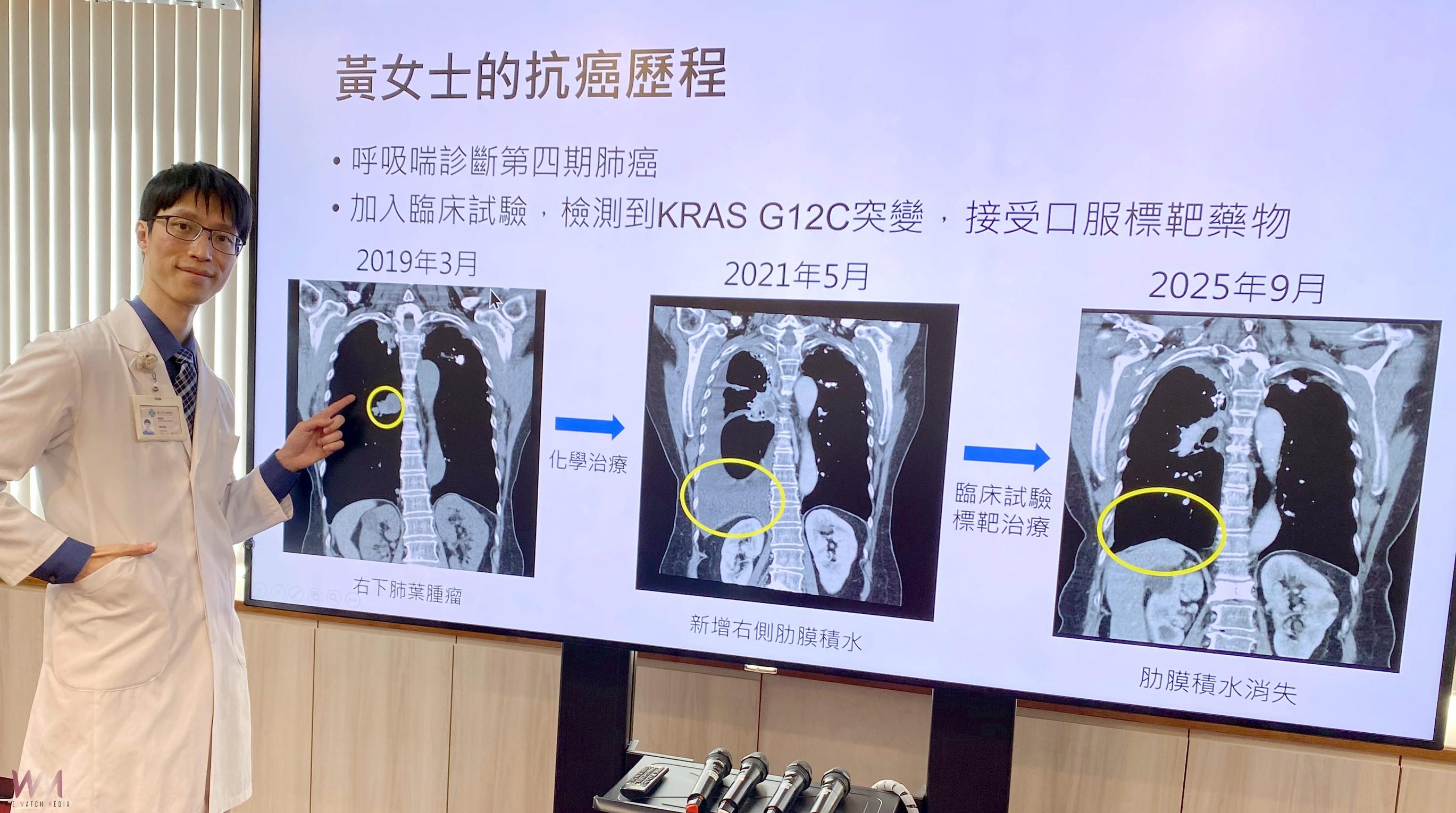 精準醫療改寫肺癌命運　四期病人存活逾6年 扭轉絕望為希望 - https://www.watchmedia01.com